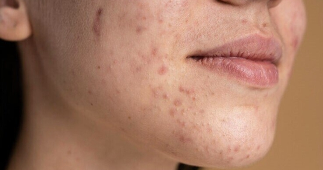 Chocolate causa acne e espinhas? Especialista esclarece