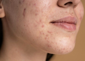 Chocolate causa acne e espinhas? Especialista esclarece