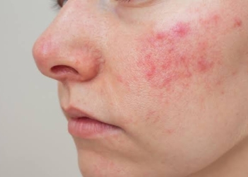Rosácea: o que é, principais sintomas e como tratar a condição de pele que afeta milhões