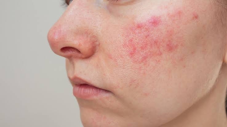 Rosácea: o que é, principais sintomas e como tratar a condição de pele que afeta milhões