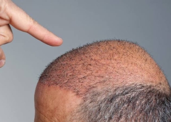 Cabelos de volta: O que está por trás do boom dos implantes capilares?