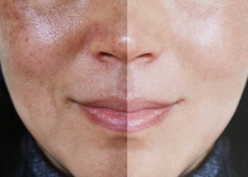 Melasma: Como lidar com as manchas e recuperar sua confiança
