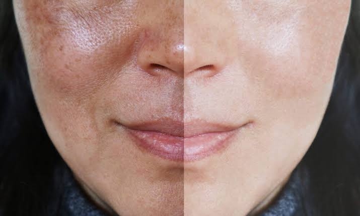 Melasma: Como lidar com as manchas e recuperar sua confiança